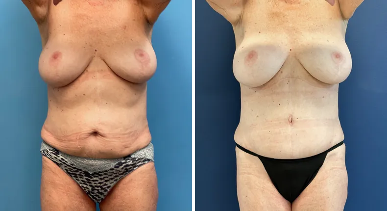 Before and after tummy tuck: patient's abdomen from the front, with liposuction