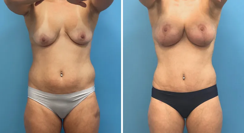 Before and after tummy tuck: patient's abdomen from the front, with body lift, breast augmentation with lift and liposuction
