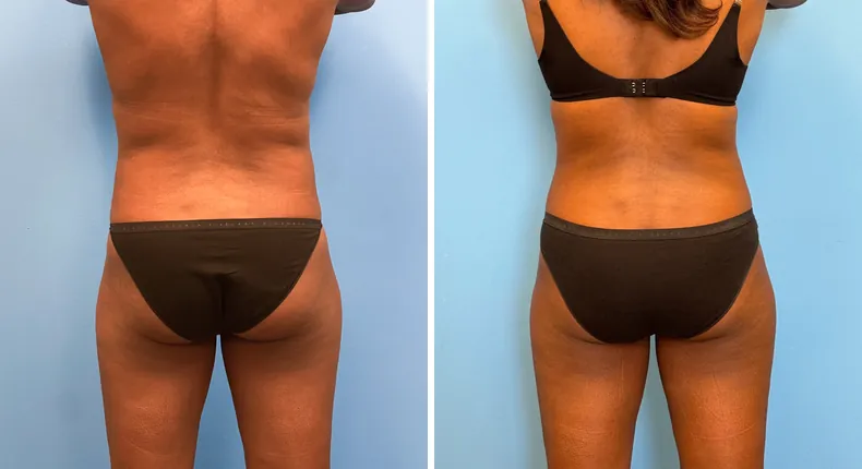 Before and after tummy tuck: patient's abdomen from the back