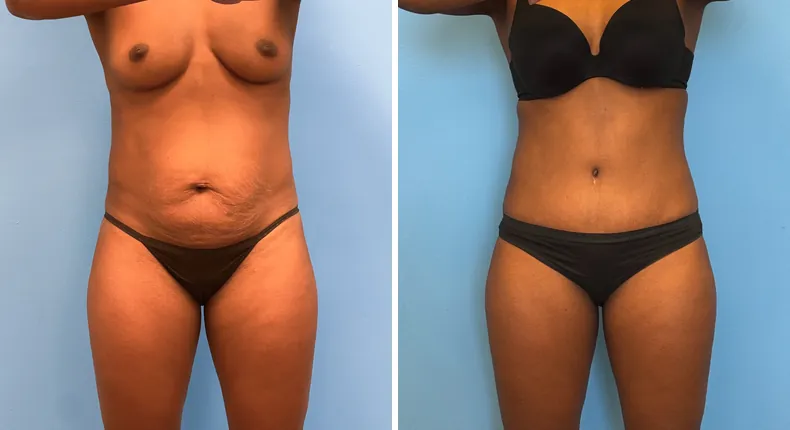 Before and after tummy tuck: patient's abdomen from the front