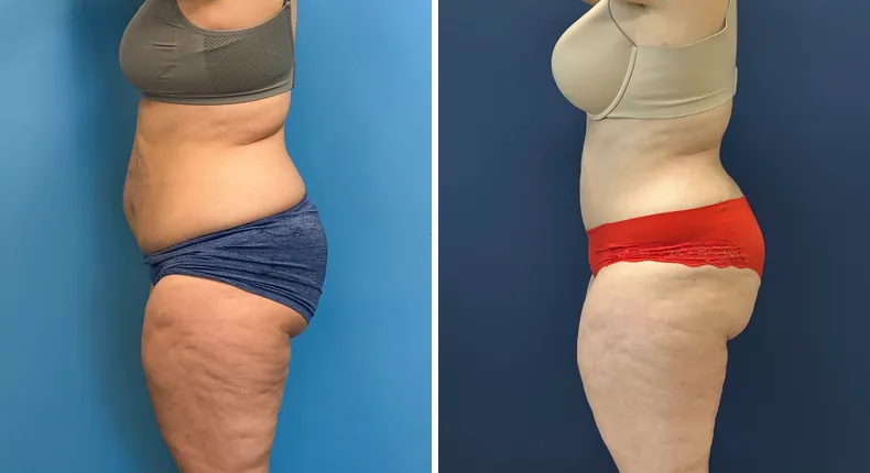 Before and after tummy tuck: patient's abdomen from the left side