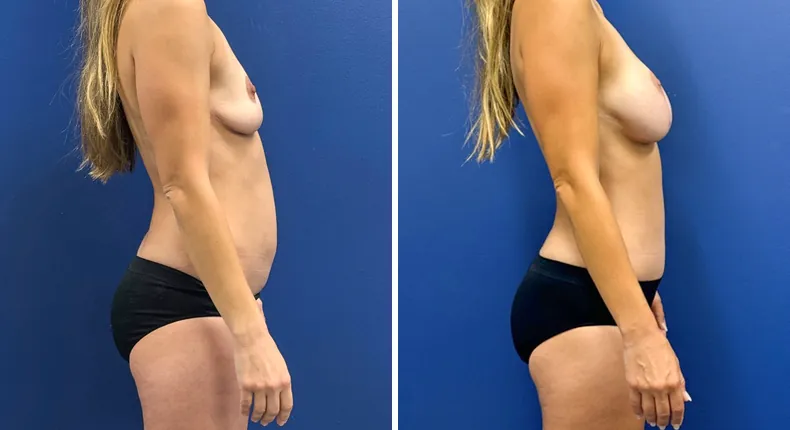 Before and after tummy tuck: patient's abdomen from the right side, with breast augmentation with lift and liposuction