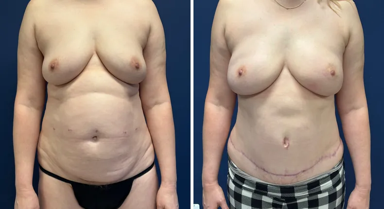 Before and after tummy tuck: woman's abdomen, with liposuction and breast reconstruction