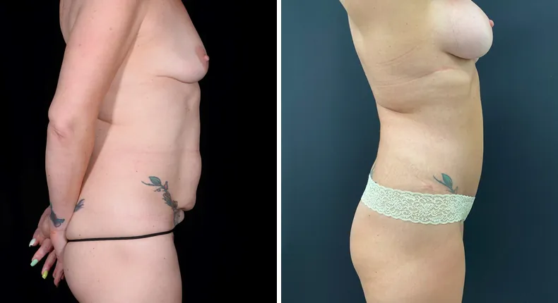 Before and after tummy tuck: patient's abdomen from the right side, with breast augmentation