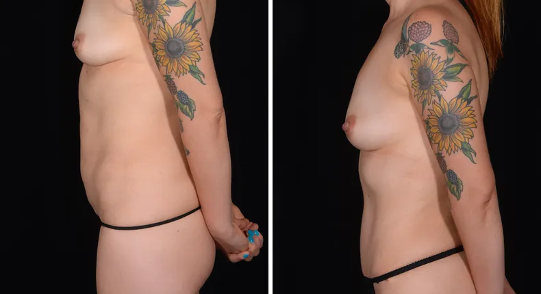 Before and after tummy tuck: patient's abdomen from the left side