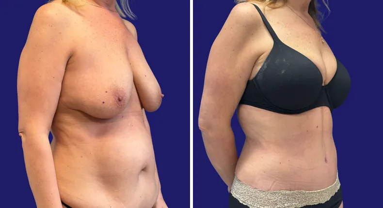 Before and after tummy tuck: woman's abdomen, with liposuction