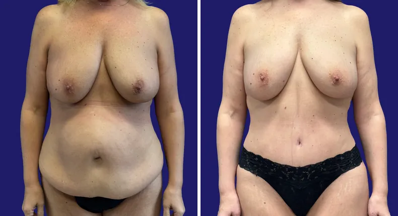 Before and after tummy tuck: woman's abdomen, with liposuction