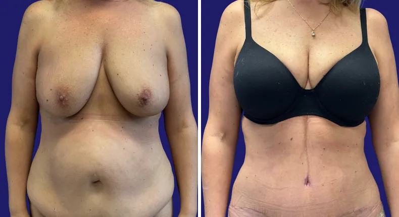 Before and after tummy tuck: woman's abdomen from the front, with liposuction