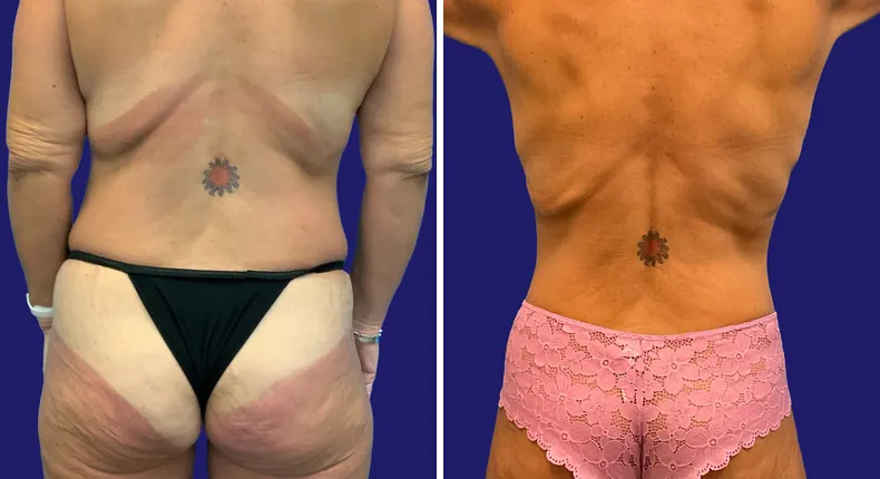 Before and after tummy tuck: woman's abdomen, with breast augmentation, breast lift, liposuction, mommy makeover and arm lift