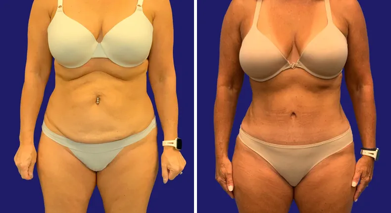 Before and after tummy tuck: woman's abdomen, with liposuction and mommy makeover