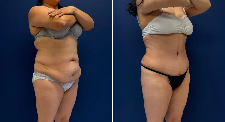 Before and after tummy tuck: patient's abdomen