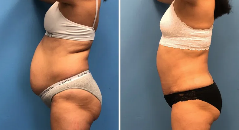 Before and after tummy tuck: woman's abdomen from the left side, with liposuction