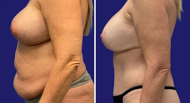 Before and after tummy tuck: woman's abdomen, with breast reconstruction, breast augmentation with lift and liposuction