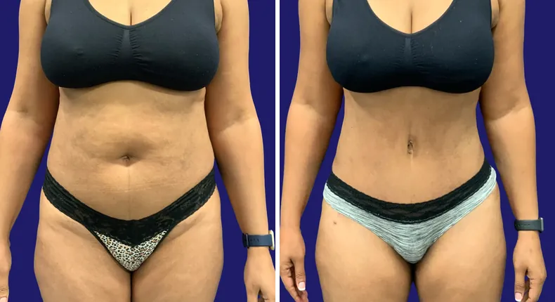 Before and after tummy tuck: woman's abdomen, with liposuction