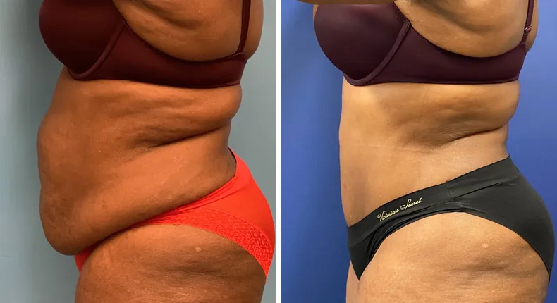 Before and after tummy tuck: patient's abdomen in left profile
