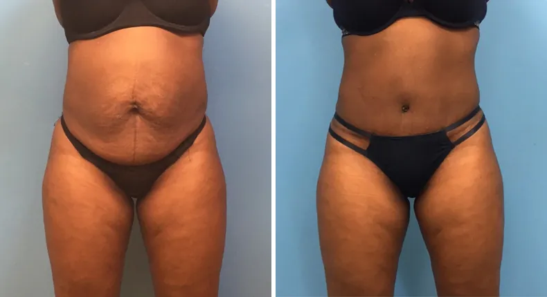 Before and after tummy tuck: woman's abdomen from the front, with liposuction