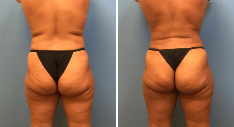 Before and after tummy tuck: patient's abdomen from the back, with liposuction