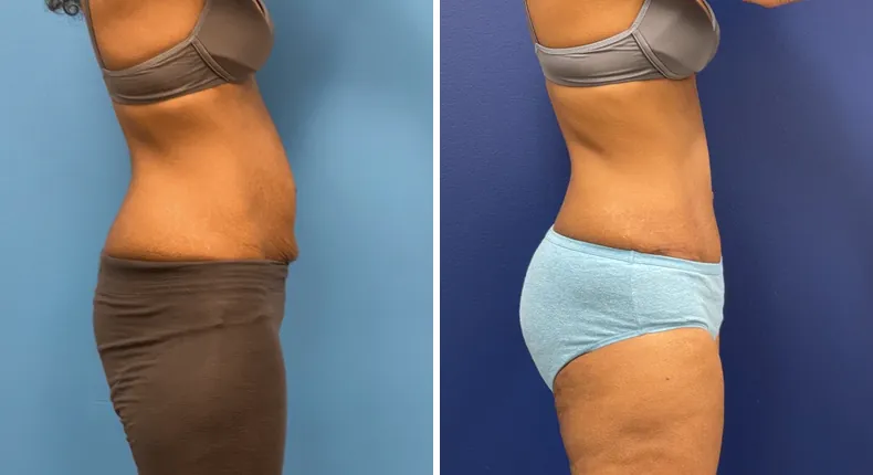 Before and after tummy tuck: patient's abdomen from the right side, with liposuction
