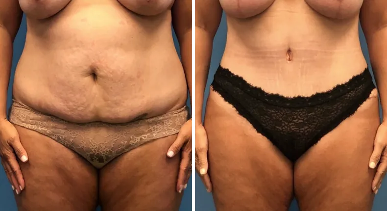 Before and after tummy tuck: woman's abdomen from the front, with liposuction and mommy makeover