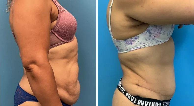 Before and after tummy tuck: patient's abdomen from the right side