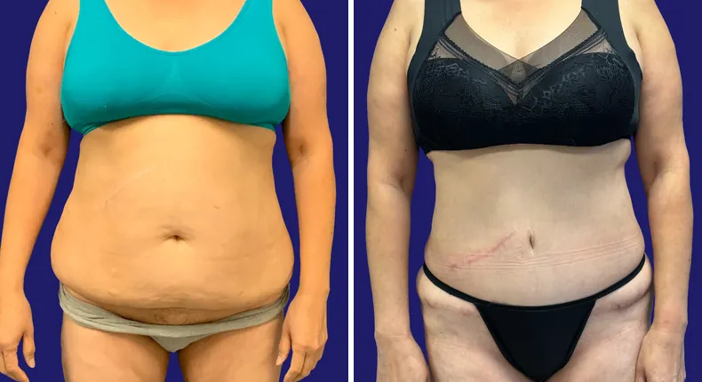 Before and after tummy tuck: woman's abdomen from the front, with eyelid surgery, liposuction and brazilian butt lift (bbl)