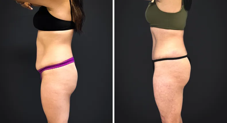Before and after tummy tuck: patient's abdomen from the left side