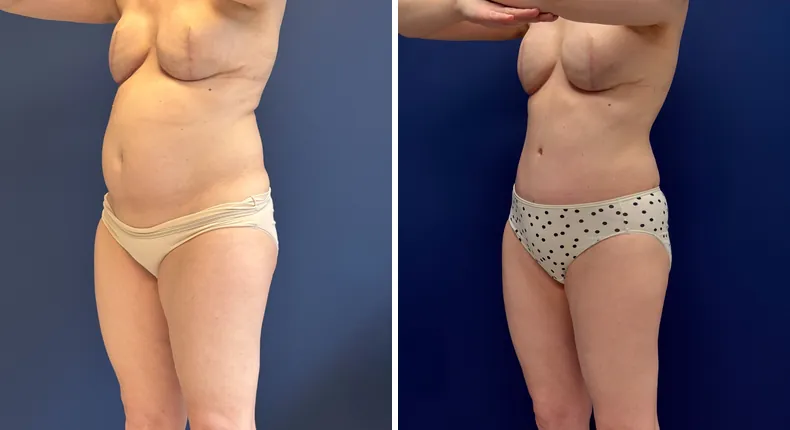 Before and after tummy tuck: patient's abdomen
