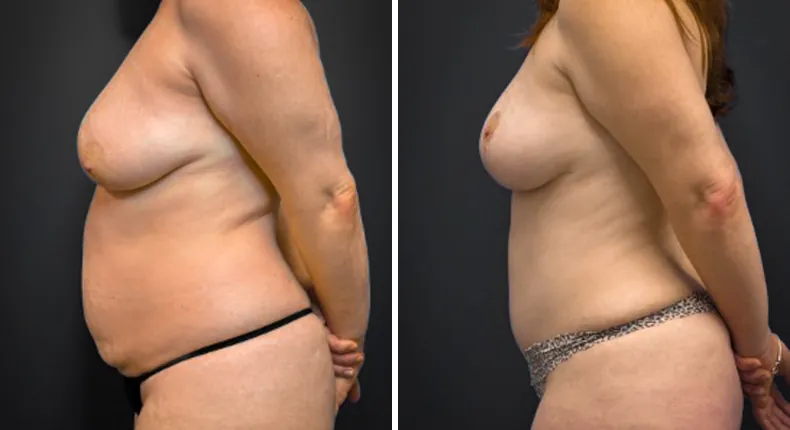 Before and after tummy tuck: patient's abdomen from the left side