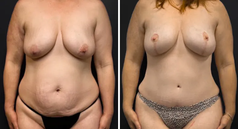 Before and after tummy tuck: patient's abdomen from the front