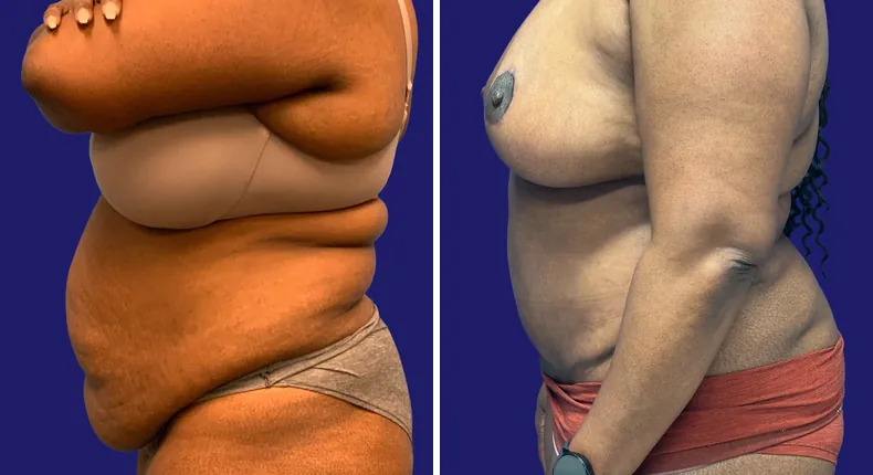 Before and after tummy tuck: woman's abdomen, with breast reduction and liposuction