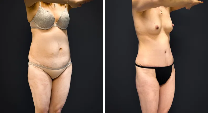 Before and after tummy tuck: patient's abdomen from the right side