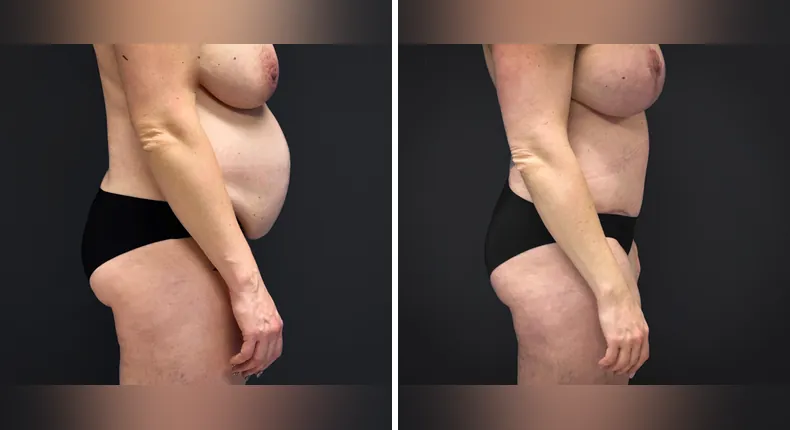 Before and after tummy tuck: patient's abdomen from the left side, with liposuction