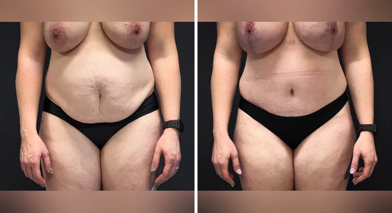 Before and after tummy tuck: patient's abdomen from the front, with liposuction