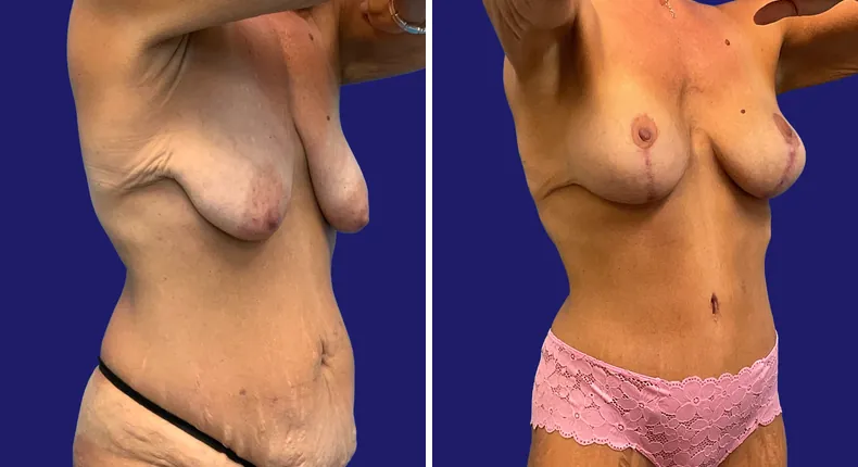 Before and after tummy tuck: woman's abdomen, with breast augmentation, breast lift, liposuction, mommy makeover and arm lift