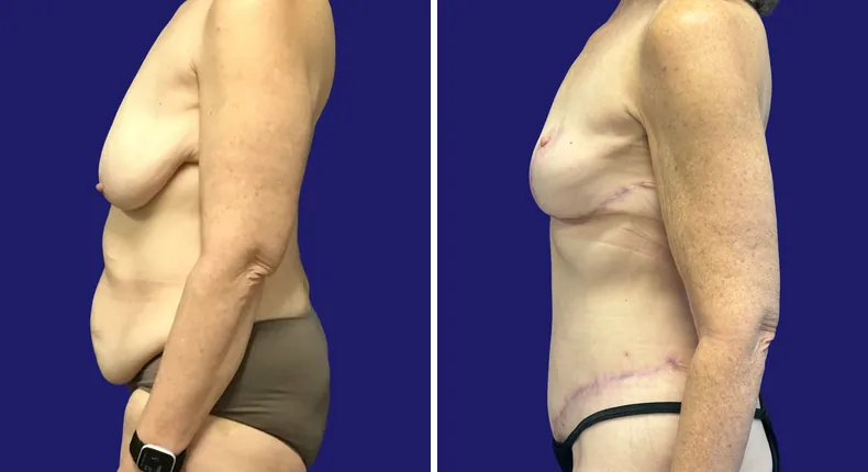 Before and after tummy tuck: woman's abdomen, with liposuction and mommy makeover