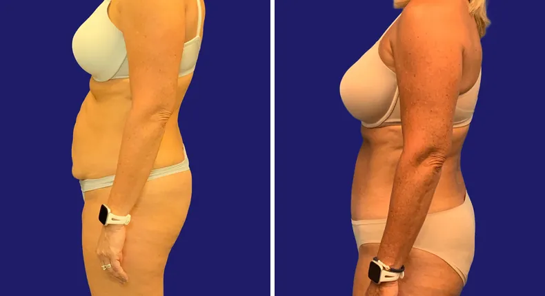 Before and after tummy tuck: woman's abdomen, with liposuction and mommy makeover