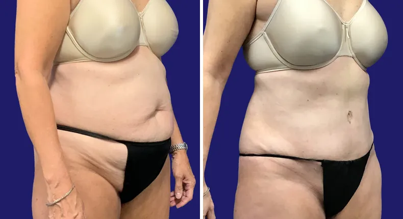 Before and after tummy tuck: patient's abdomen, with breast reconstruction and liposuction