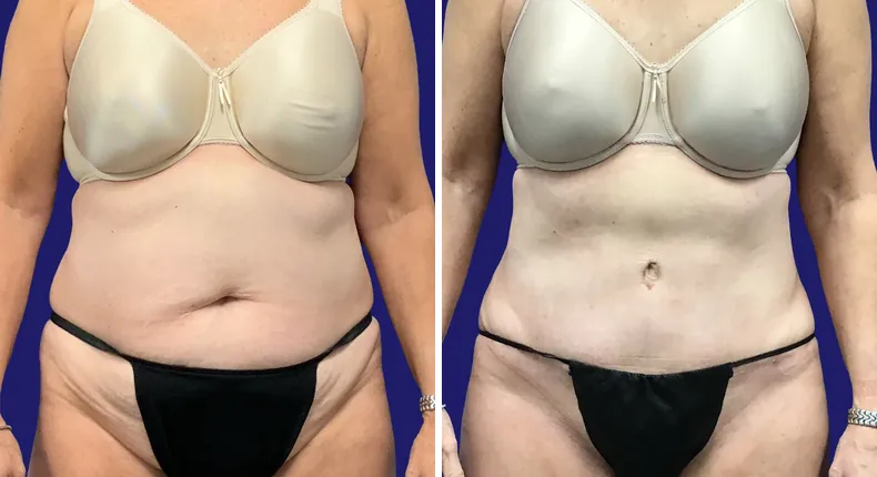 Before and after tummy tuck: patient's abdomen, with breast reconstruction and liposuction
