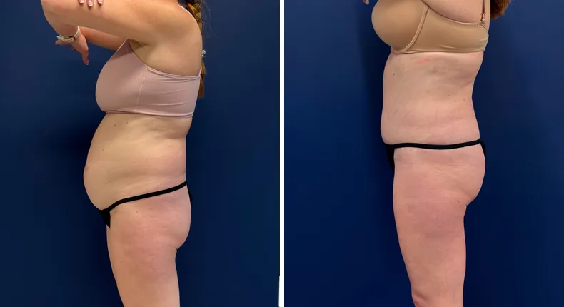 Before and after tummy tuck: patient's abdomen