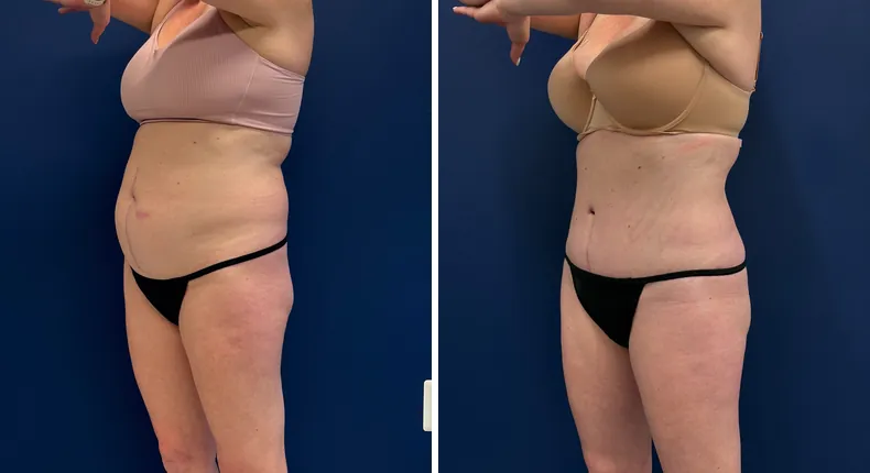 Before and after tummy tuck: patient's abdomen
