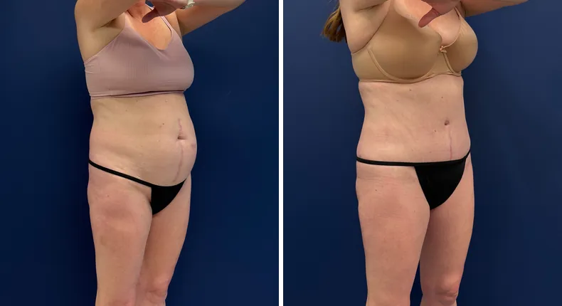 Before and after tummy tuck: patient's abdomen
