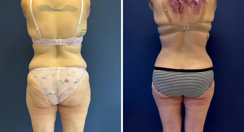 Before and after tummy tuck: patient's abdomen
