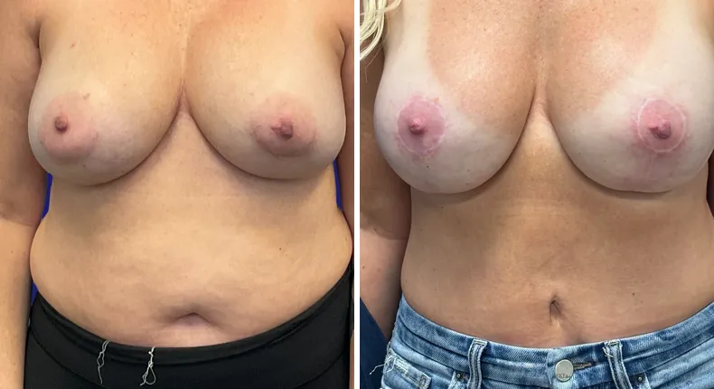 Before and after tummy tuck: woman's abdomen, with breast reconstruction, breast augmentation with lift and liposuction