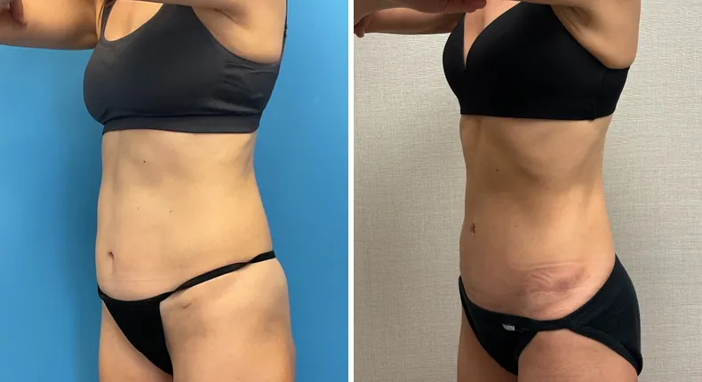 Before and after tummy tuck: patient's abdomen at a left angle