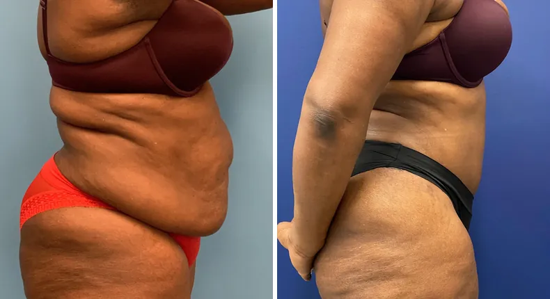 Before and after tummy tuck: patient's abdomen in right profile