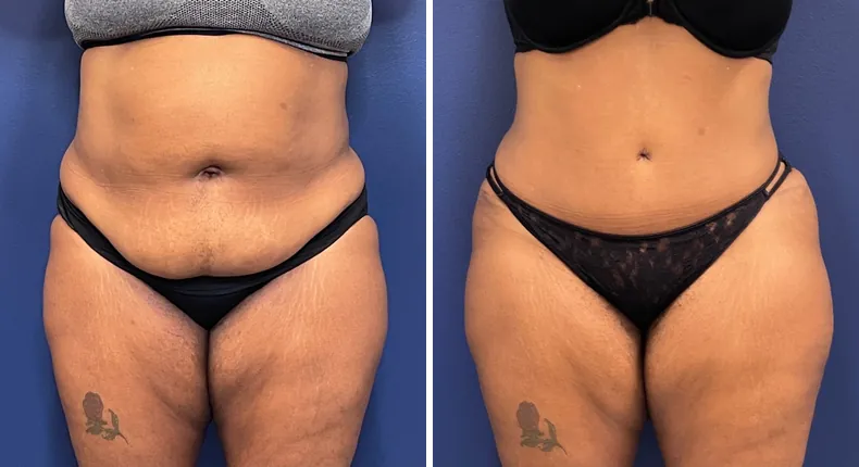 Before and after tummy tuck: patient's abdomen from the front, with liposuction