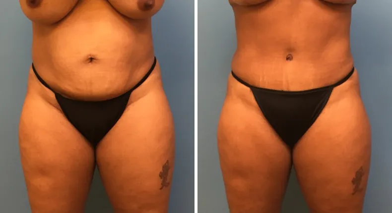 Before and after tummy tuck: patient's abdomen from the front, with liposuction