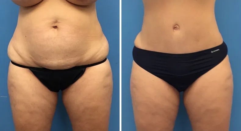 Before and after tummy tuck: patient's abdomen from the front, with liposuction