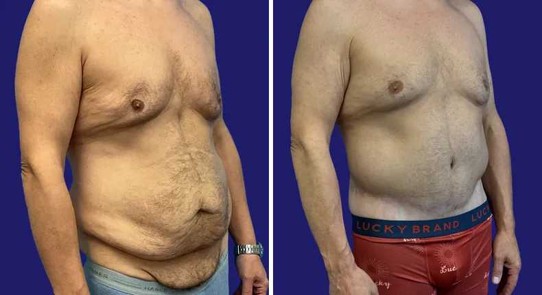 Before and after tummy tuck: man's abdomen, with liposuction and body lift