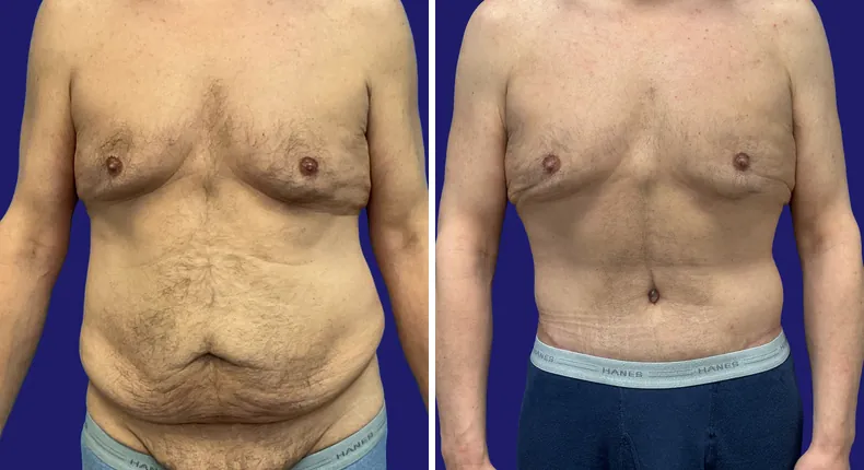 Before and after tummy tuck: man's abdomen, with liposuction and body lift